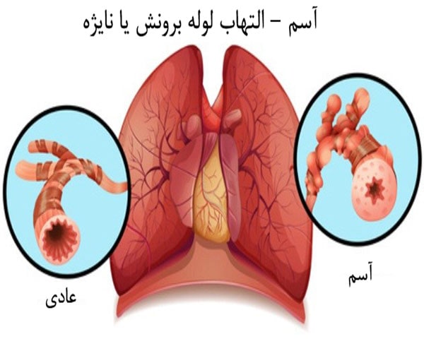 بیماری آسم چیست؟